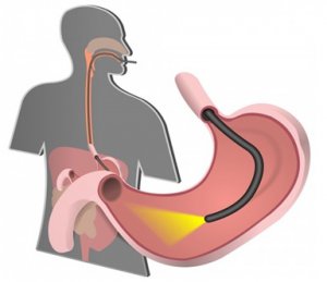 ЭГДС (эзофагогастродуоденоскопия) в Медицинском центре «Аква Мед Марин»