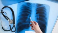 Новости » Общество: Роспотребнадзор запустил «горячую» линию по вопросам профилактики туберкулеза