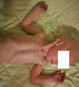 Прокуратура начала проверку после поста в соцсети о сильно истощенном малыше из крымского детдома